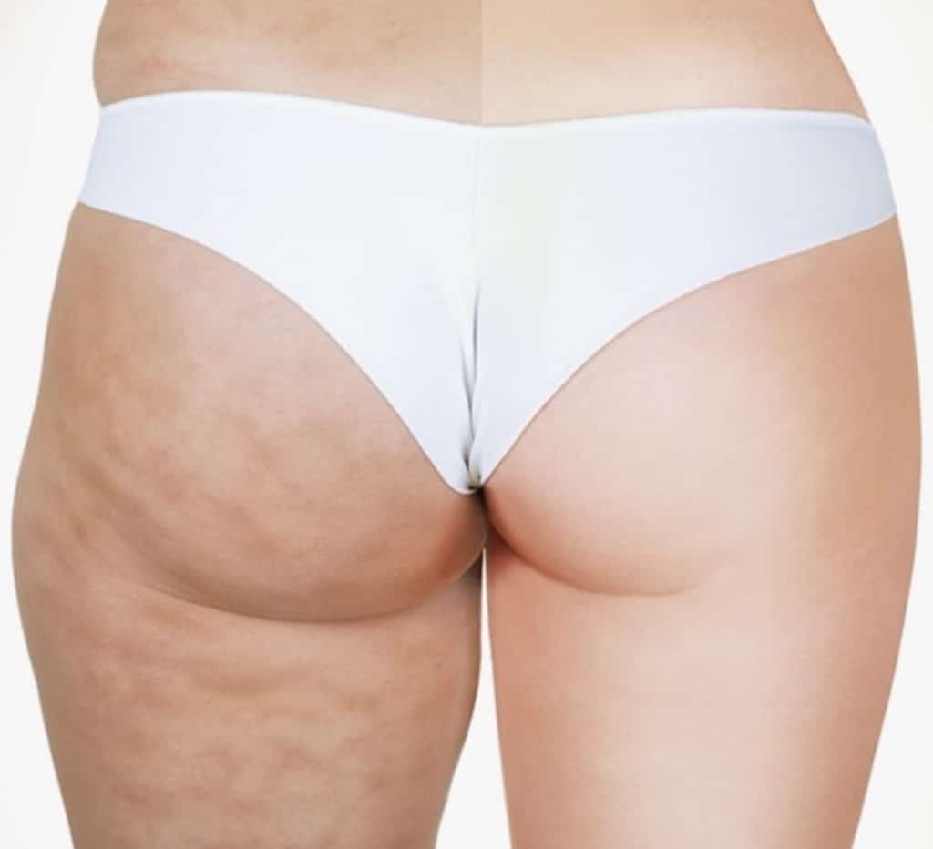 Les Différents Types de Cellulite par Centre Koel : Institut de Beauté alternatif à la Chirurgie, Expert en Amincissement