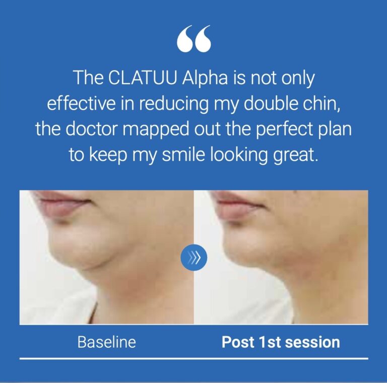 Cryolipolyse Clatuu Alpha de Classys disponible chez Centre Koel