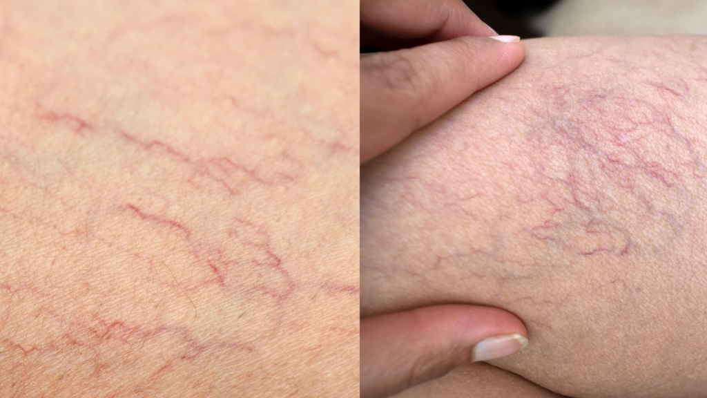 Les veines de l’araignée : comment s’en débarrasser en douceur grâce aux techniques de soins esthétiques du Centre Koel