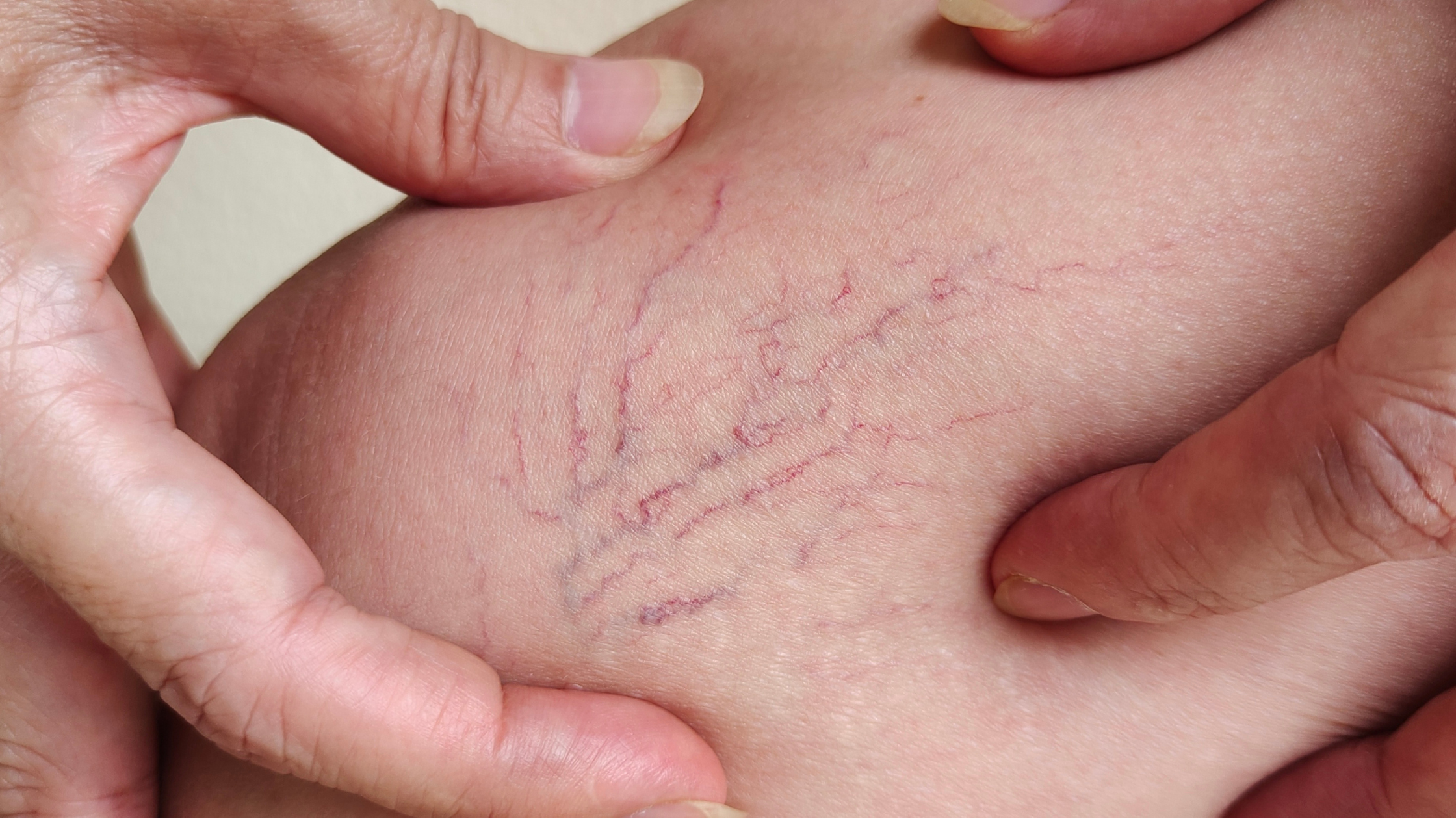 Les veines de l’araignée : comment s’en débarrasser en douceur grâce aux techniques de soins esthétiques du Centre Koel