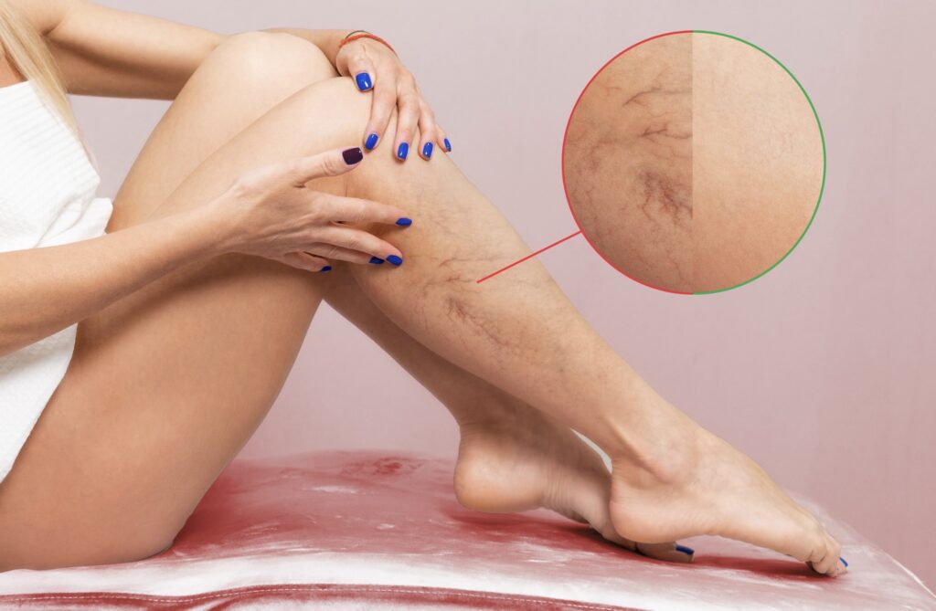 Les veines de l’araignée : comment s’en débarrasser en douceur grâce aux techniques de soins esthétiques du Centre Koel