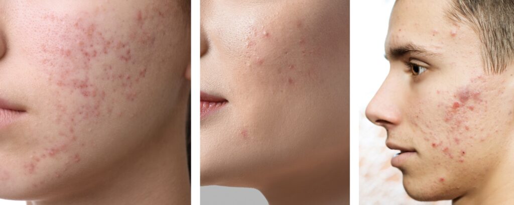 Les soins personnalisés Centre Koel contre les imperfections, rougeurs, cicatrices, acné, excès de sébum.