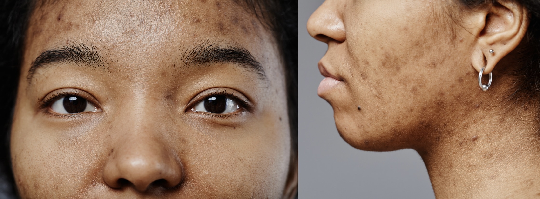 Le guide complet des soins peelings pour les peaux noires et pourquoi choisir le Centre Koel pour votre peau.