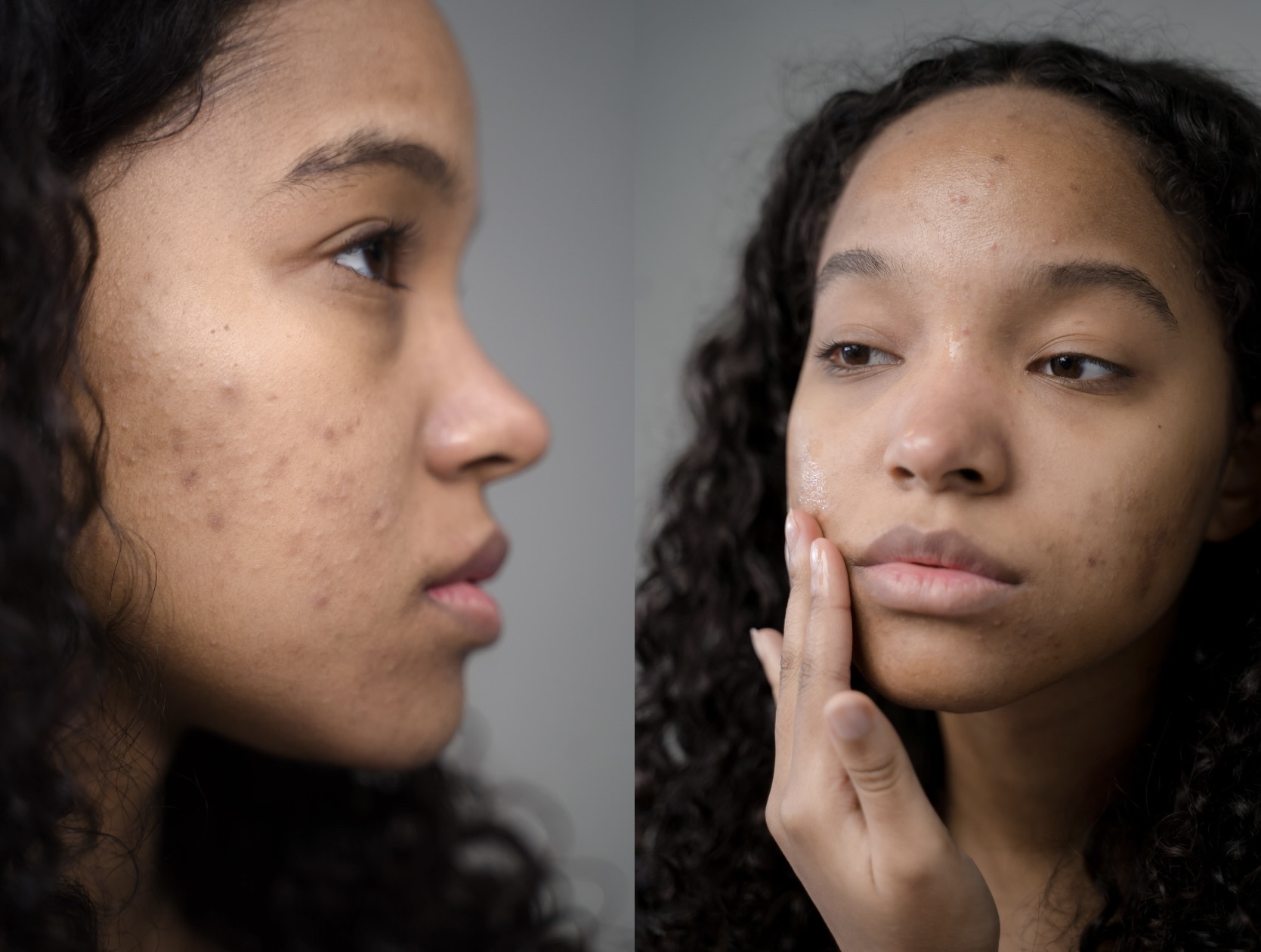 Le guide complet des soins peelings pour les peaux noires et pourquoi choisir le Centre Koel pour votre peau.