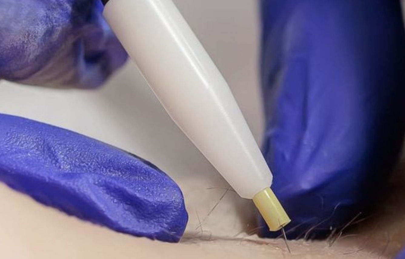 Epilation électrolyse Centre Koel