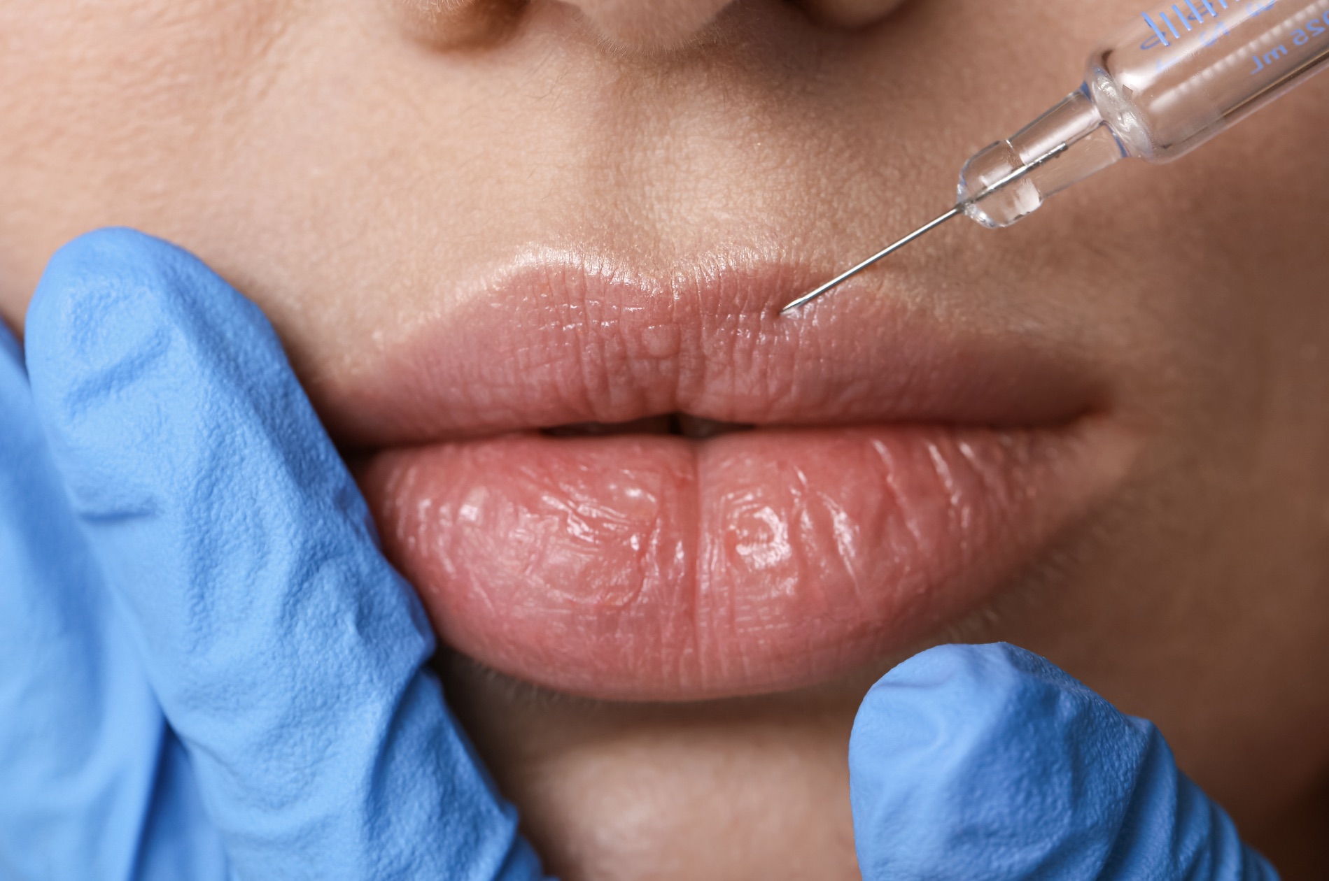 Les injections d’acide hyaluronique chez Koel Med