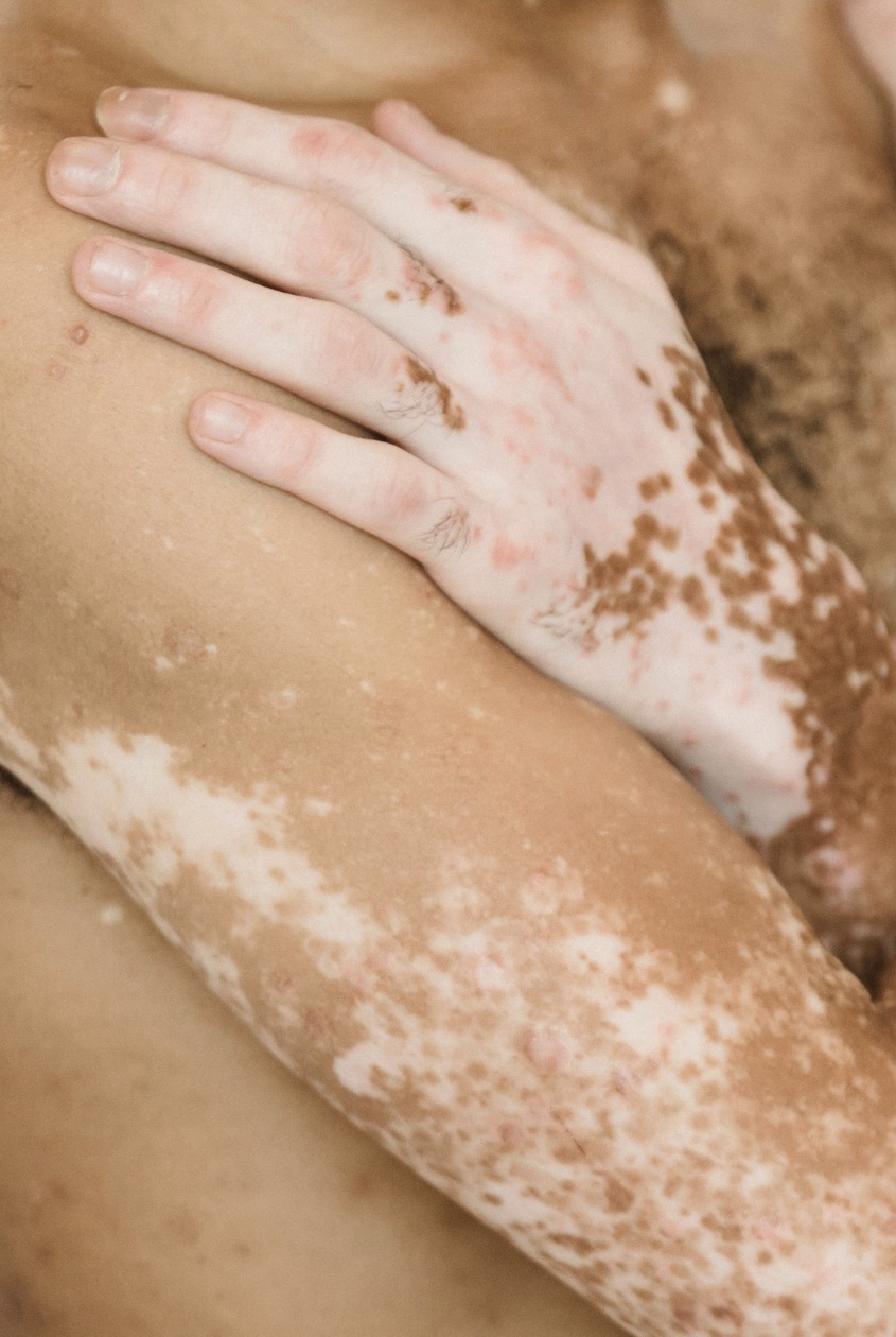 Épilation Laser et Vitiligo : l'Expertise Centre Koel