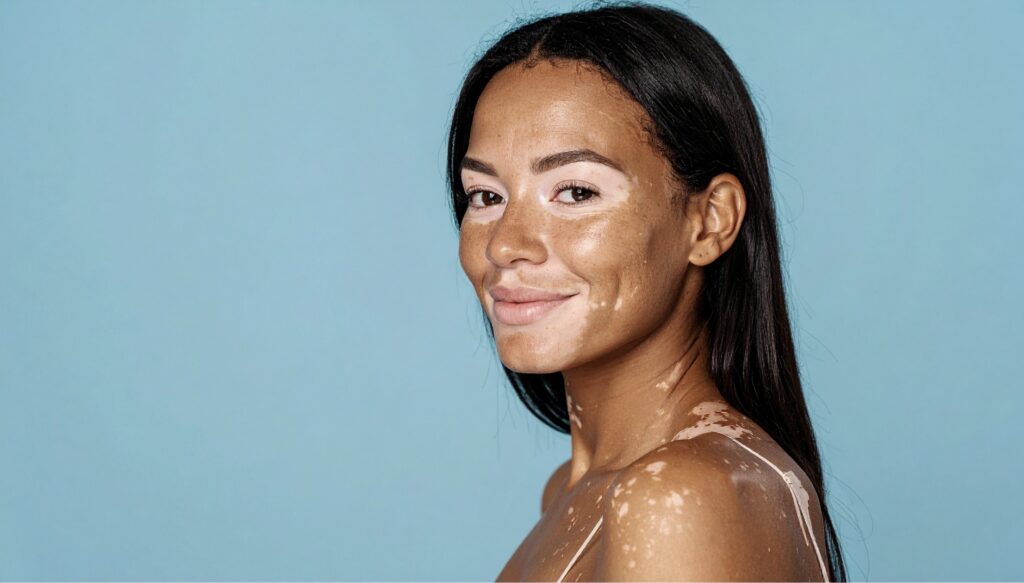 Épilation Laser et Vitiligo : l'Expertise Centre Koel
