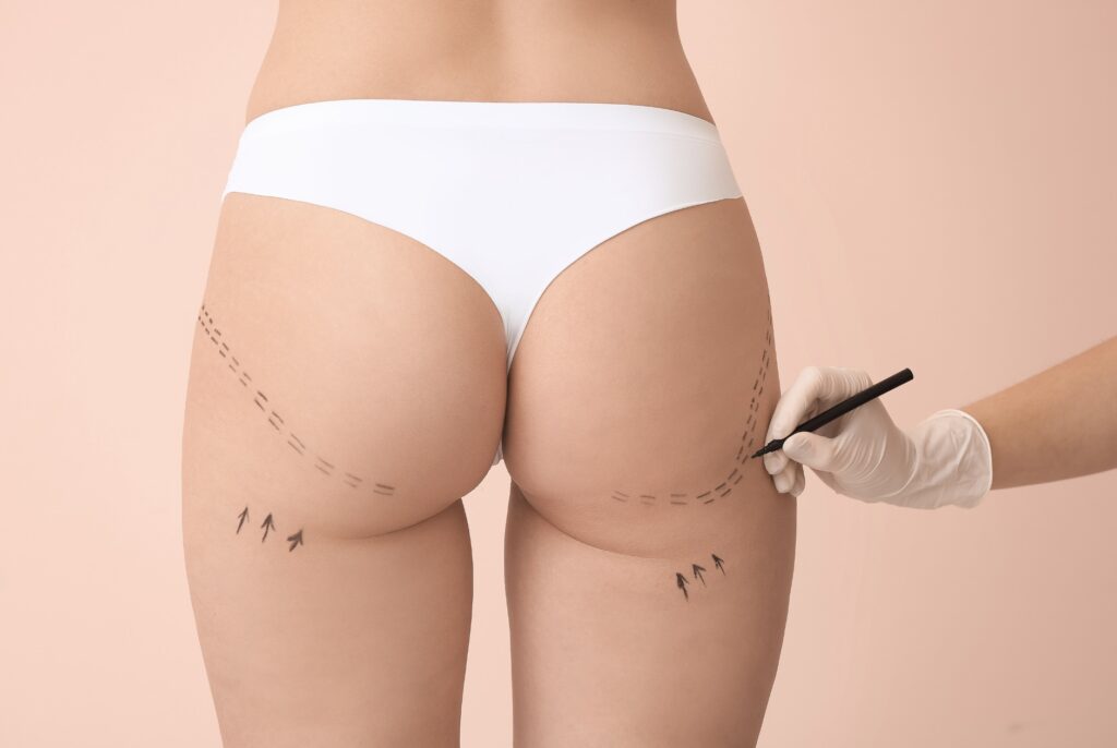 Liposuccion, Drainage Lymphatique, Endosphères Therapy : Le Guide Complet Centre Koel pour une Récupération Optimale