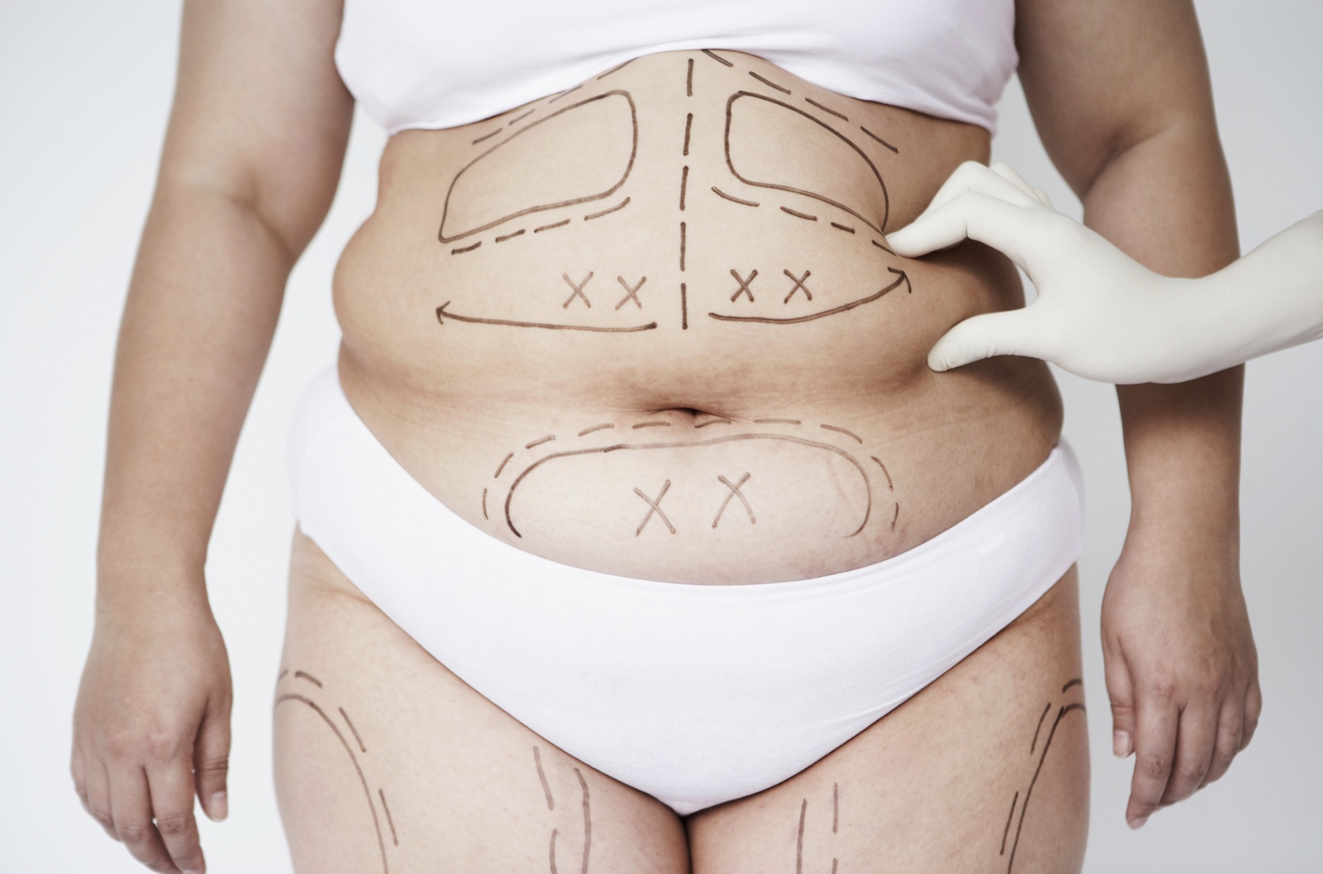 Liposuccion, Drainage Lymphatique, Endosphères Therapy : Le Guide Complet Centre Koel pour une Récupération