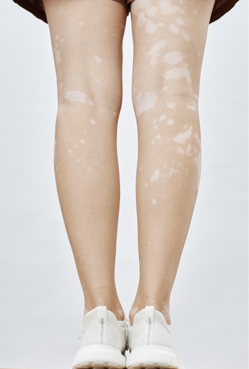 Épilation Laser et Vitiligo : l'Expertise Centre Koel