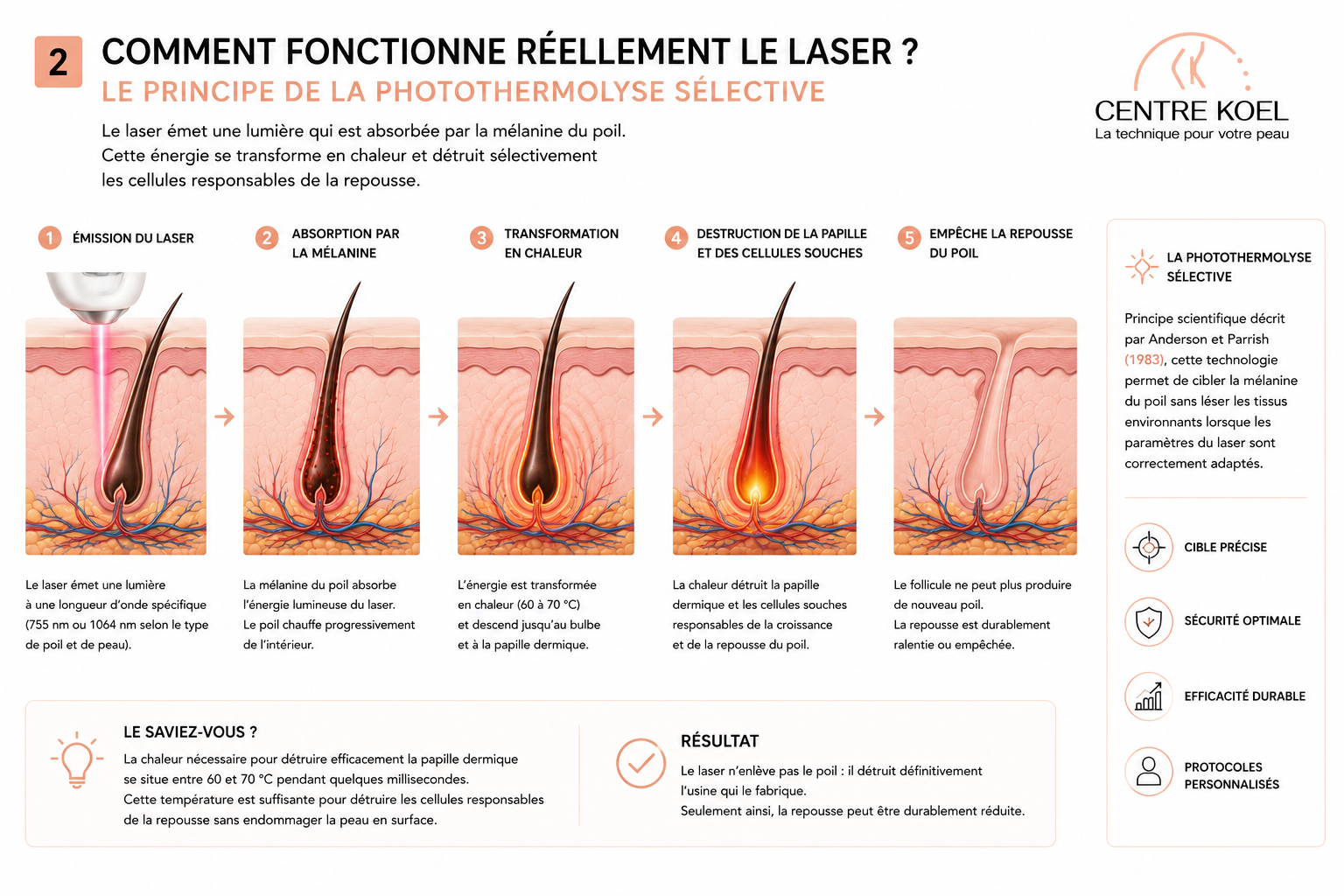 Schéma sur le fonctionnement du laser en épilation définitive par Centre Koel, votre expert en épilation définitive et laser homme et femme